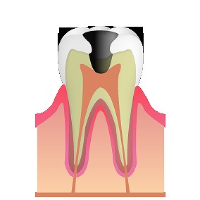 むし歯の進行 C3