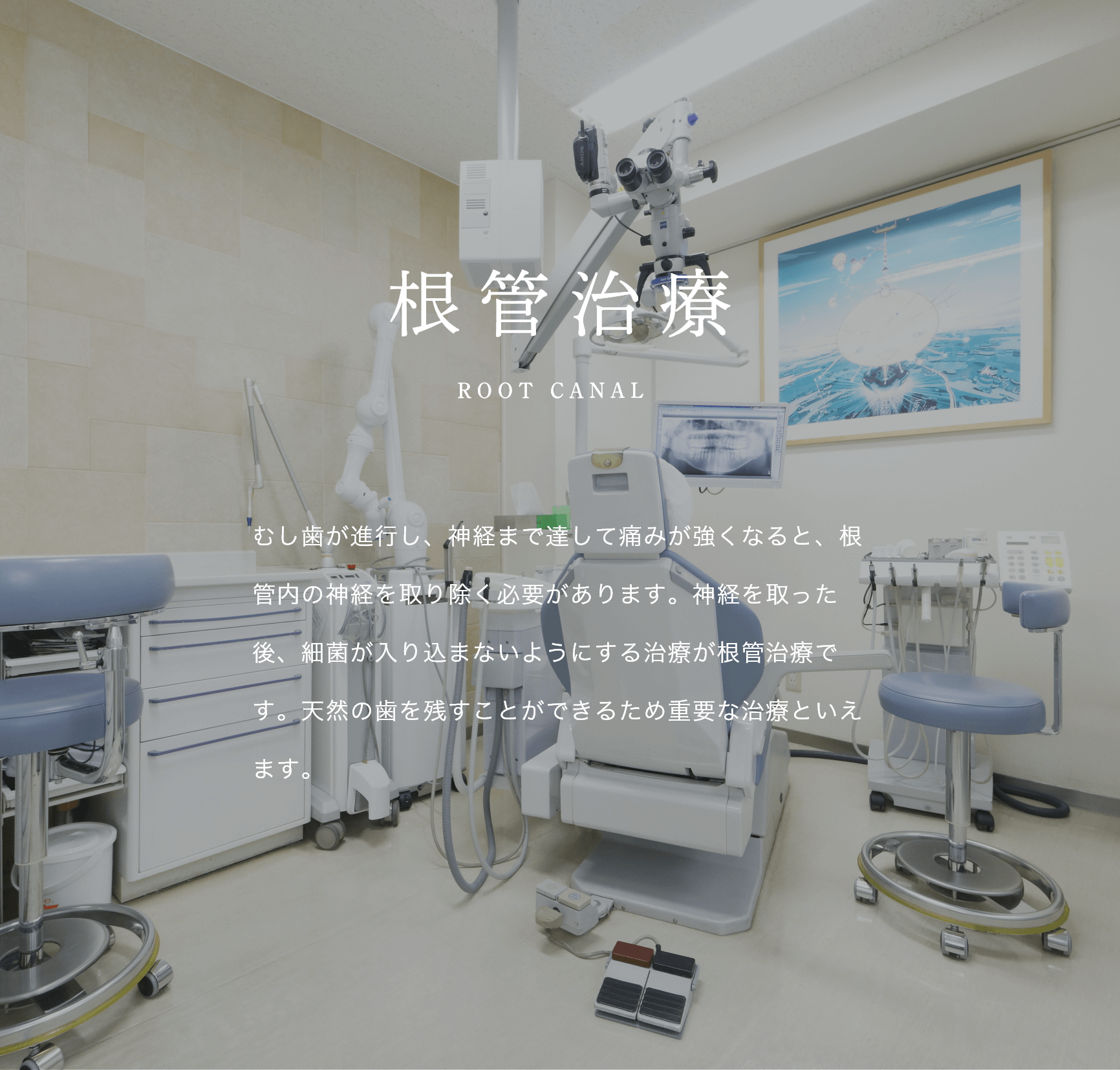 文京区後楽園・飯田橋の歯医者・矯正歯科「文京いわぶち歯科・矯正歯科」|根管治療 ROOT CANAL むし歯が進行し、神経まで達して痛みが強くなると、根管内の神経を取り除く必要があります。神経を取った後、細菌が入り込まないようにする治療が根管治療です。天然の歯を残すことができるため重要な治療といえます。