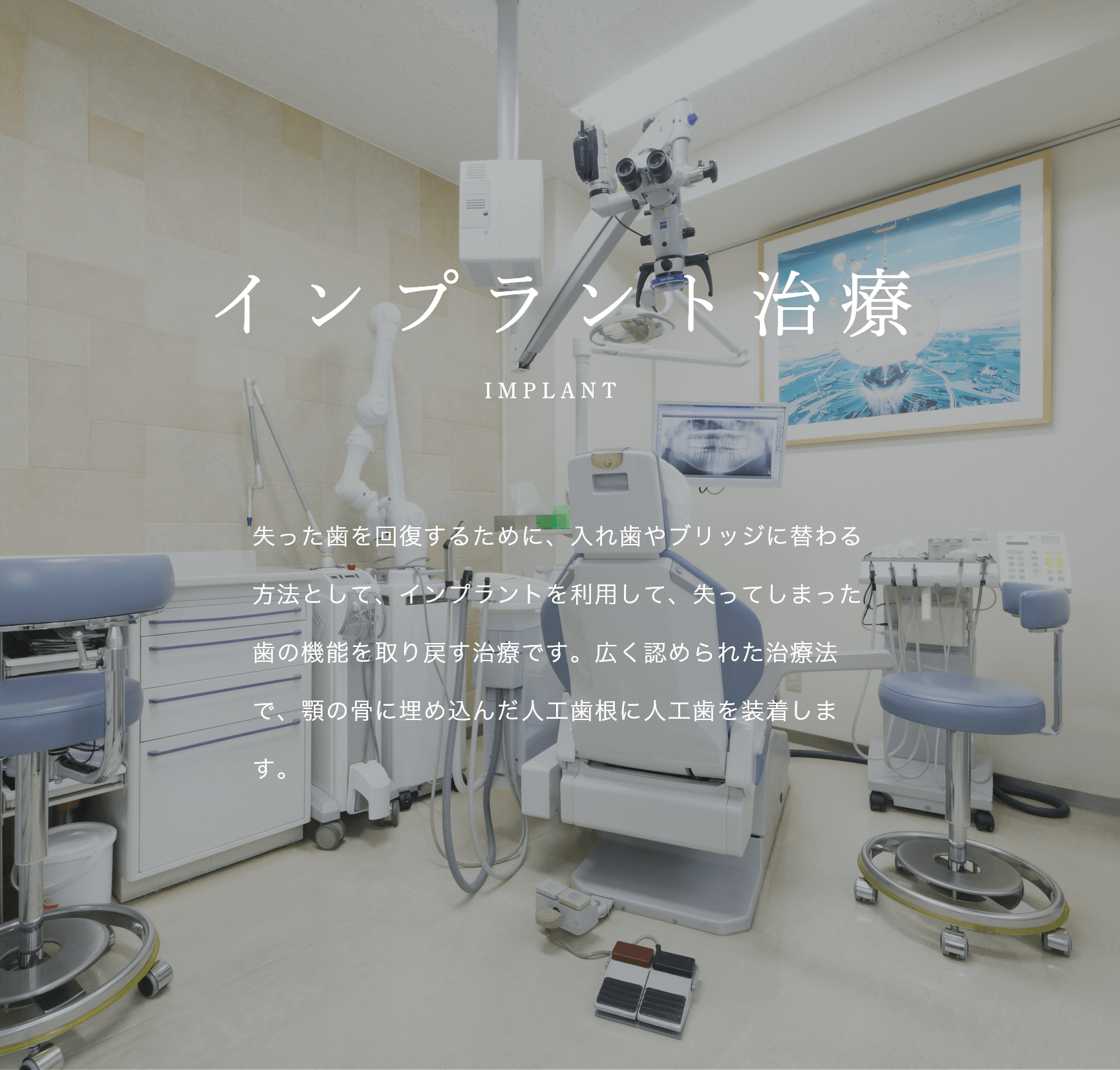 文京区後楽園・飯田橋の歯医者・矯正歯科「文京いわぶち歯科・矯正歯科」|インプラント治療 IMPLANT 失った歯を回復するために、入れ歯やブリッジに替わる方法として、インプラントを利用して、失ってしまった歯の機能を取り戻す治療です。広く認められた治療法で、顎の骨に埋め込んだ人工歯根に人工歯を装着します。